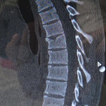 Jack Miller posted this X Ray image of his fractured vertebra on his Facebook page
